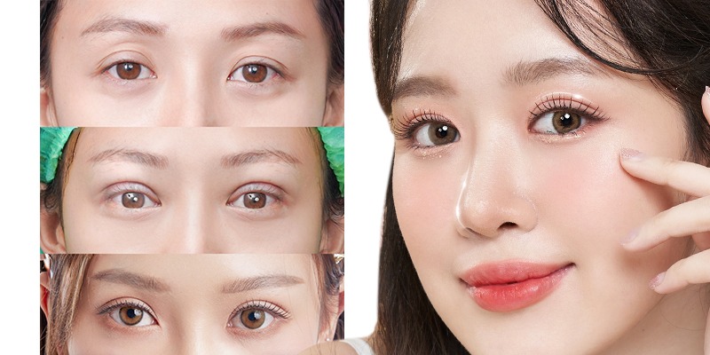 các loại cắt mí mắt