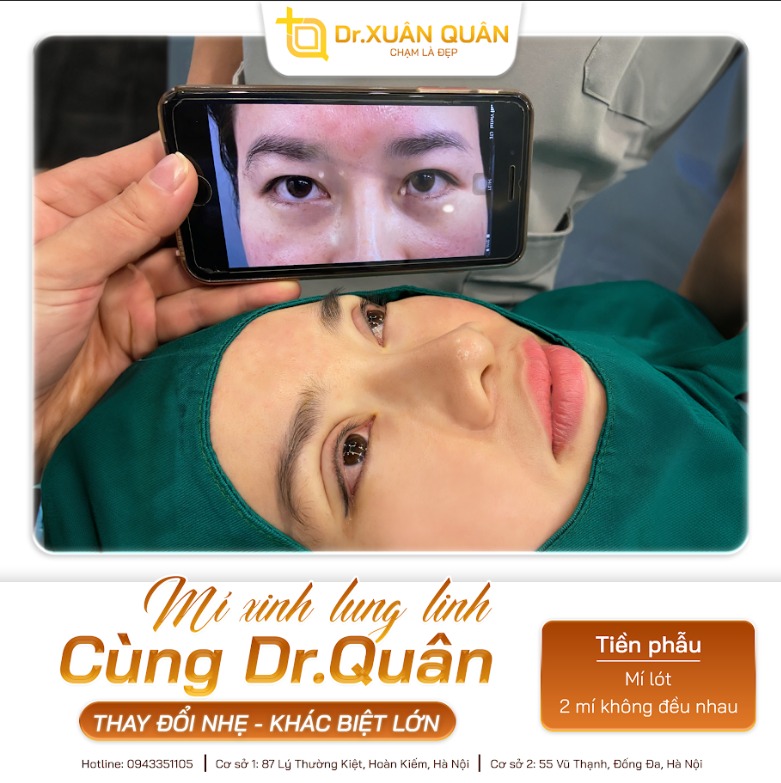 Khách hàng phẫu thuật tạo hình mắt tại Thẩm mỹ Dr Xuân Quân