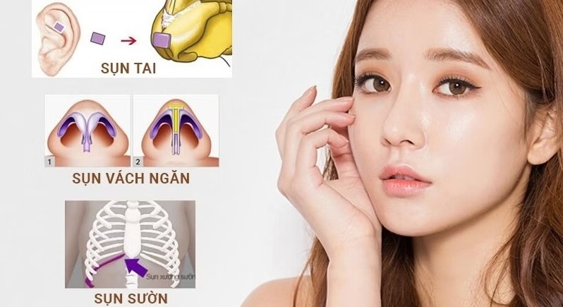 Common types of nasal cartilage implants currently available Các loại sụn nâng mũi