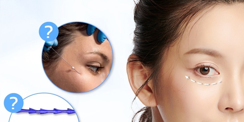 Căng chỉ mắt: Giải pháp trẻ hóa vùng mắt không cần phẫu thuật Căng chỉ mắt là gì?