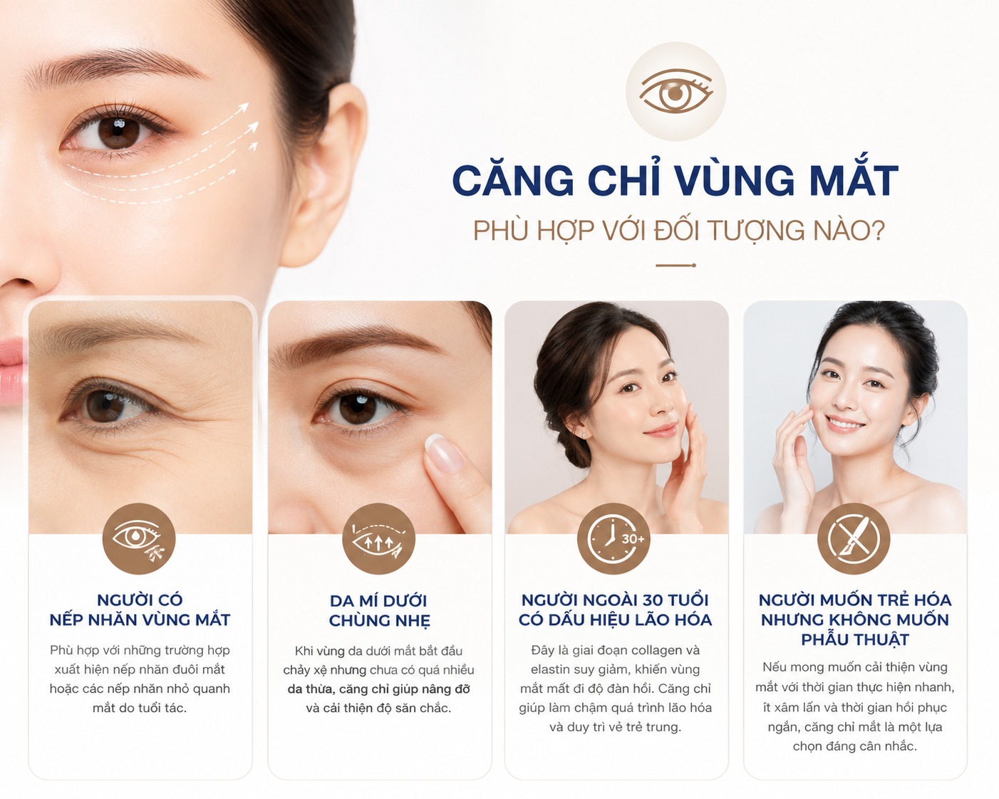Căng chỉ mắt: Giải pháp trẻ hóa vùng mắt không cần phẫu thuật Căng chỉ mắt