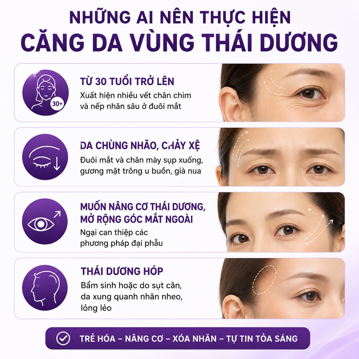 Căng da thái dương: Bí quyết xóa sổ nếp nhăn, nâng cơ mắt chảy xệ căng da thái dương