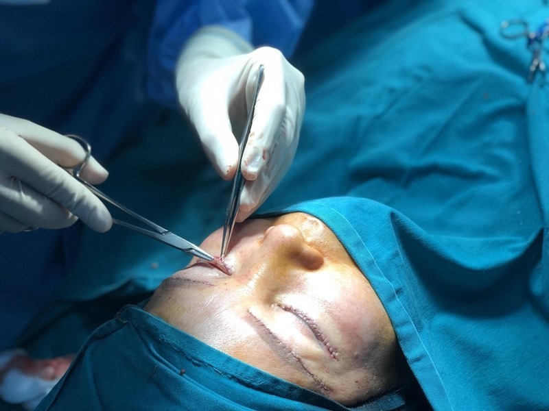 Cắt chỉ mí mắt bị sót có dấu hiệu gì? Có nguy hiểm không? Cách xử lý khi cắt chỉ mí mắt bị sót
