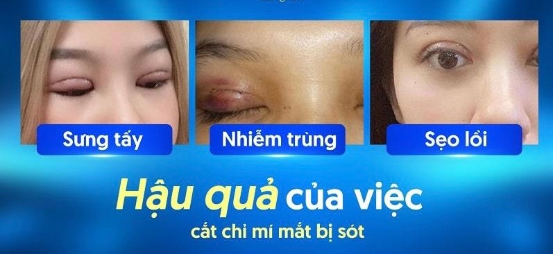Cắt chỉ mí mắt bị sót có dấu hiệu gì? Có nguy hiểm không? Dấu hiệu nhận biết cắt chỉ mí mắt bị sót