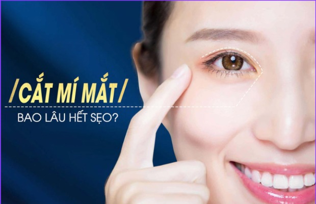 Cắt mí bao lâu hết sẹo? Các mốc hồi phục cần biết