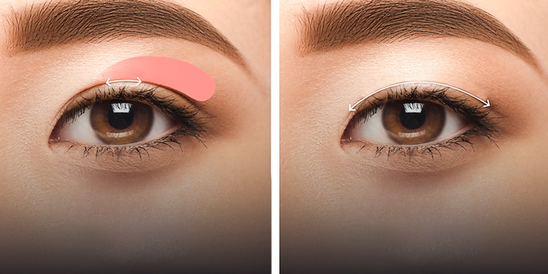 How long does it take for eyelid surgery scars to completely disappear? cắt mí bao lâu hết sẹo