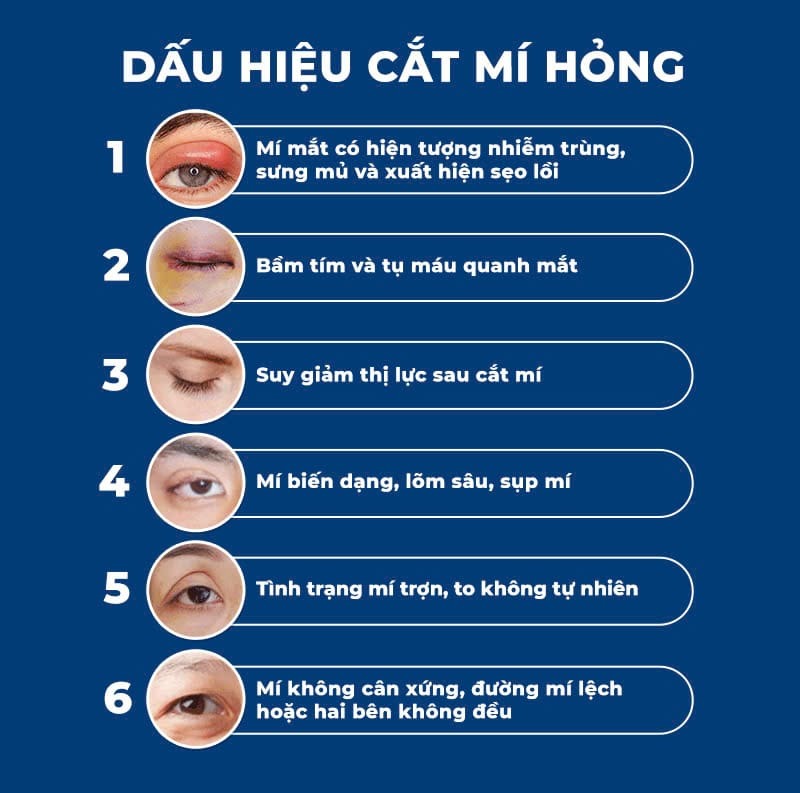 Cắt mí bị lỗi có sửa được không? Giải pháp khắc phục an toàn từ bác sĩ chuyên khoa Dấu hiệu nhận biết cắt mí bị lỗi