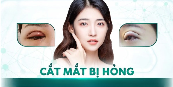 Cắt mí bị lỗi có sửa được không? Giải pháp khắc phục an toàn từ bác sĩ chuyên khoa Nguyên nhân khiến cắt mí bị lỗi