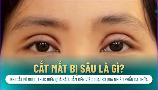 Cắt mí bị sâu có sửa được không? Có phải biến chứng sau cắt mí không? Cắt mí bị sâu là như thế nào?