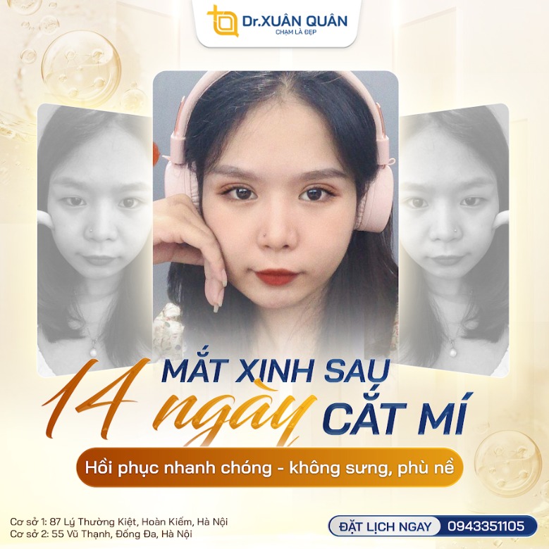 Cắt mí dưới bị lật có sao không? Cách khắc phục hiệu quả cắt mí dưới bị lật