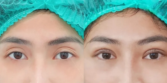 Cắt mí bị to có sửa được không? Có tự về form không? Nguyên nhân khiến cắt mí bị to hoặc lệch
