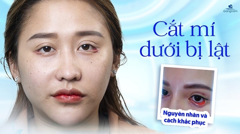 Cắt mí dưới bị lật có sao không? Cách khắc phục hiệu quả Dấu hiệu nhận biết cắt mí dưới bị lật