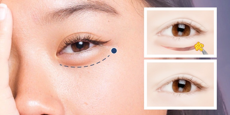 Cắt mí dưới có để lại sẹo không? Bí quyết chăm sóc mí không để lại sẹo cắt mí dưới có để lại sẹo không