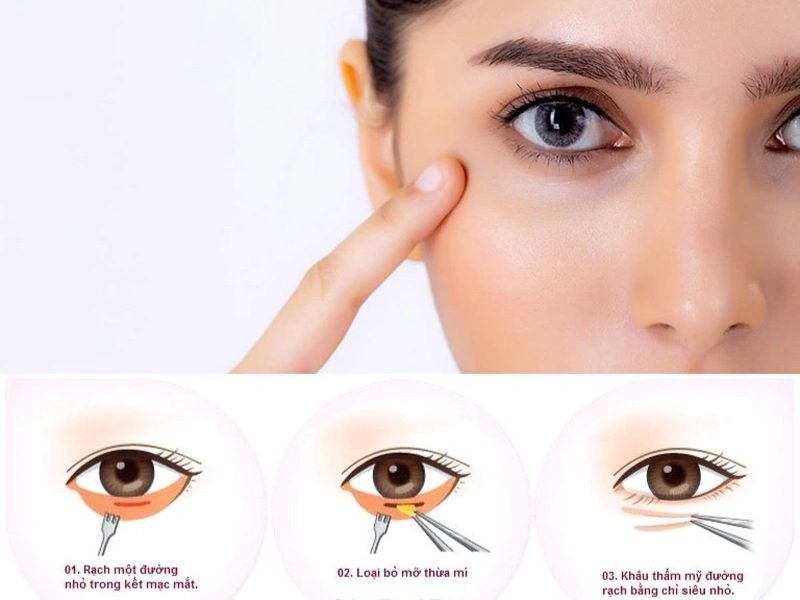 Cắt mí dưới có để lại sẹo không? Bí quyết chăm sóc mí không để lại sẹo Cắt mí dưới có để lại sẹo không?