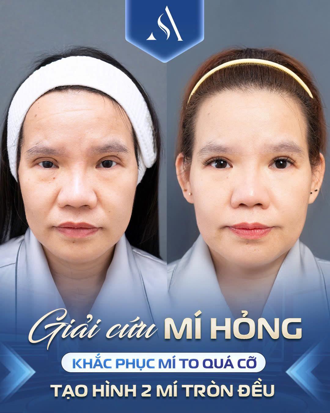 Cắt mí quá to có sửa được không? Cách khắc phục hiệu quả cắt mí quá to có sửa được không