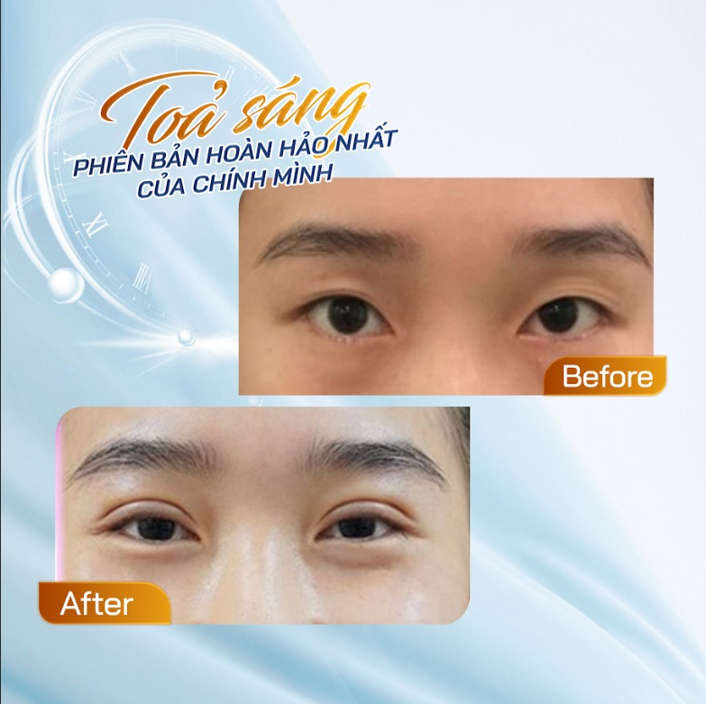 Can eyelid surgery be redone after it has already been performed? Khách hàng cắt mí tại Thẩm mỹ Dr Xuân Quân