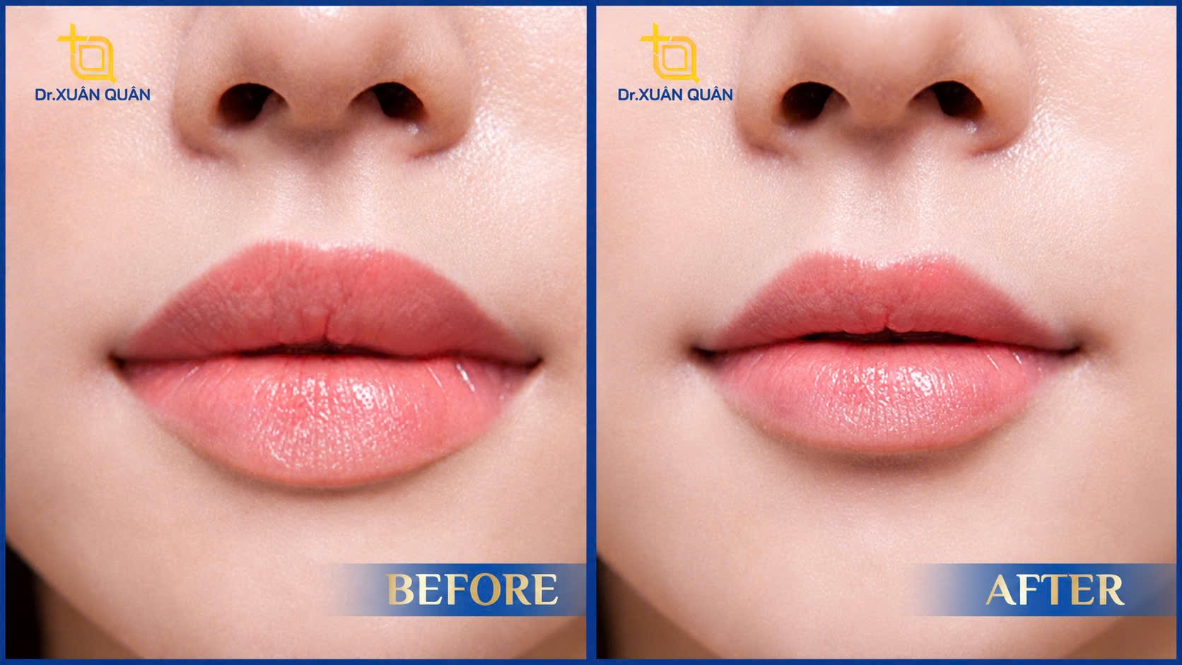 Does lip augmentation leave scars? Cắt môi trái tim có để lại sẹo không?