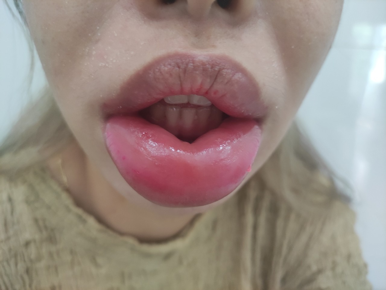 Hướng dẫn chăm sóc môi sau khi cắt giúp môi nhanh lành, lên phom chuẩn chăm sóc môi sau khi cắt