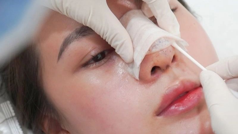 Cẩm nang chăm sóc sau nâng mũi giúp mũi nhanh vào form, đẹp bền vững chăm sóc sau nâng mũi