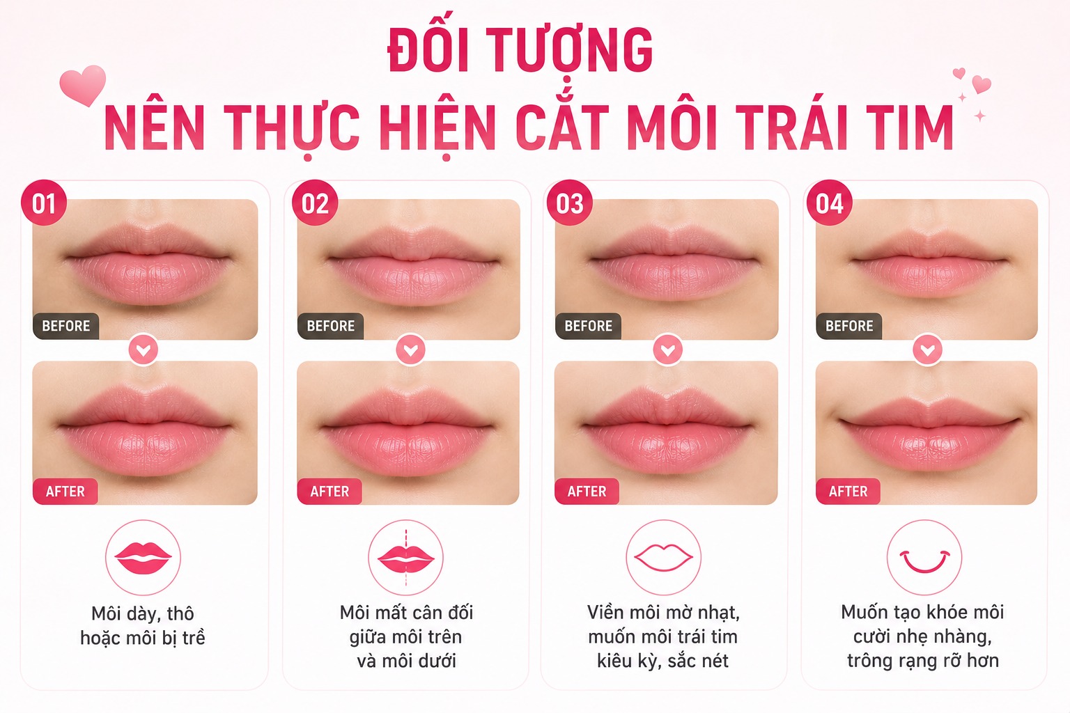 Có nên cắt môi trái tim không? Ai nên và không nên thực hiện? có nên cắt môi trái tim