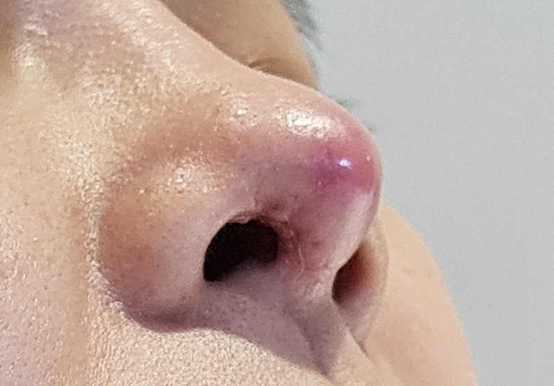 5 dấu hiệu nâng mũi bị viêm bạn cần biết để xử lý kịp thời dấu hiệu nâng mũi bị viêm