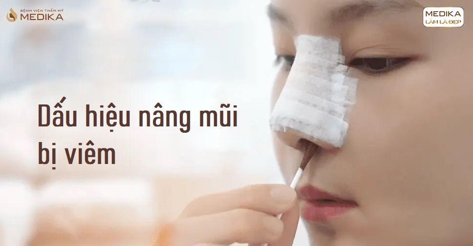 5 dấu hiệu nâng mũi bị viêm bạn cần biết để xử lý kịp thời Dấu hiệu nâng mũi bị viêm - Sưng đau và căng tức