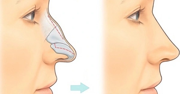 Can a nose lift be performed if the nasal bone is fractured? gãy xương mũi có nâng mũi được không