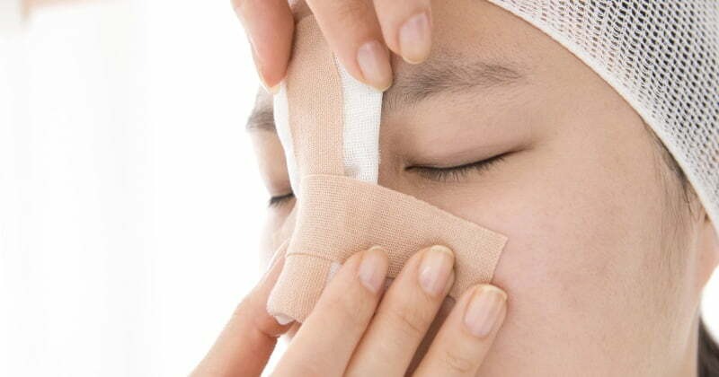 Can a nose lift be performed if the nasal bone is fractured? gãy xương mũi có nâng mũi được không