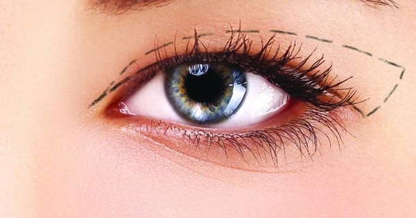 Essential information you should know about eyelid surgery from Dr. Xuan Quan Kinh nghiệm đi cắt mí mắt