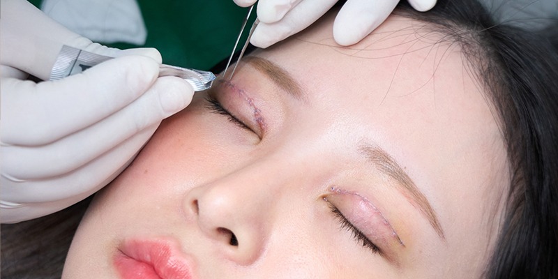 Essential information you should know about eyelid surgery from Dr. Xuan Quan Kinh nghiệm cắt mí mắt
