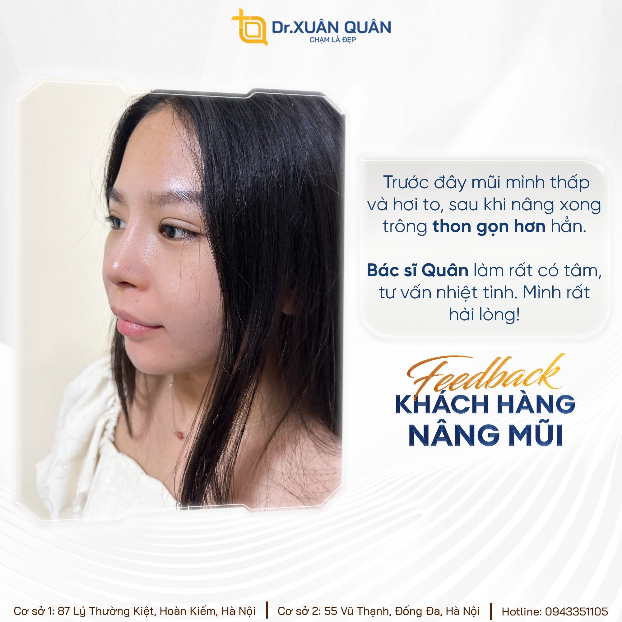 Khách hàng nâng mũi tại Thẩm mỹ Dr Xuân Quân