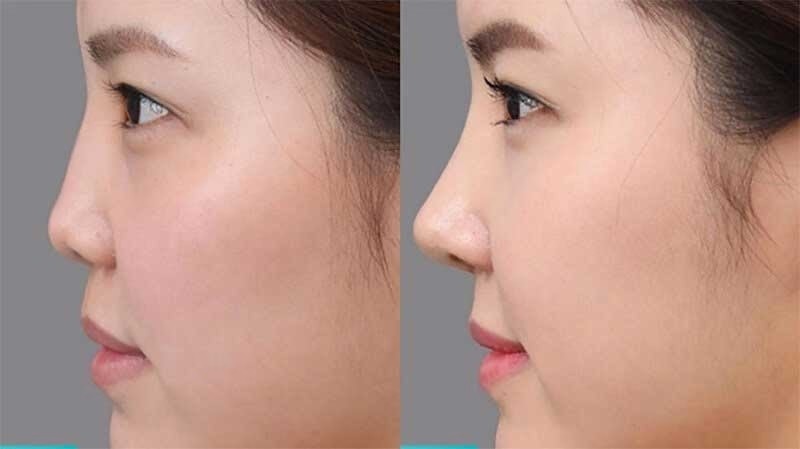 Có nên cải thiện sống mũi thấp không?
