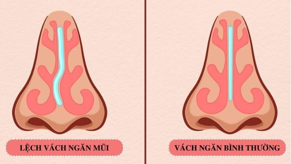 Lệch vách ngăn mũi
