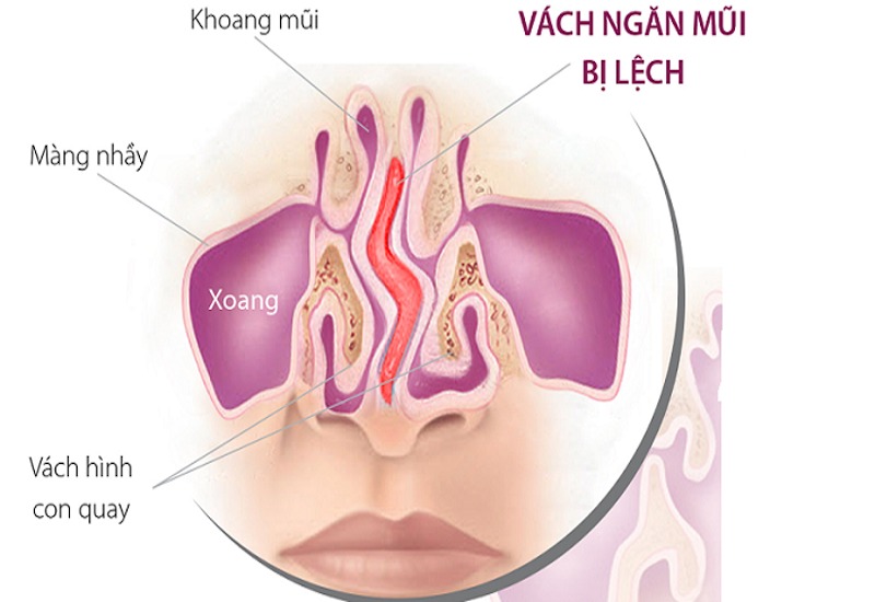 How is a deviated nasal septum treated? lệch vách ngăn mũi