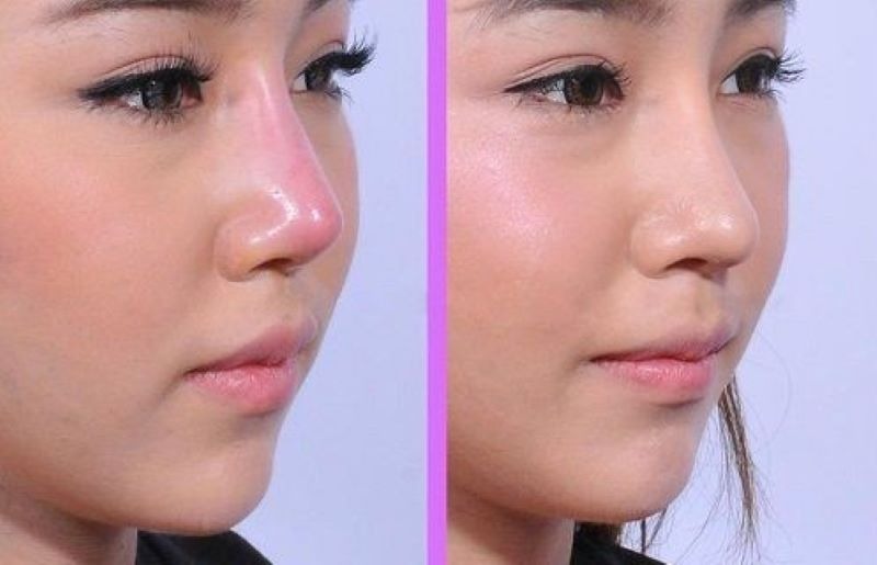 Lộ sụn đầu mũi có nguy hiểm không?
