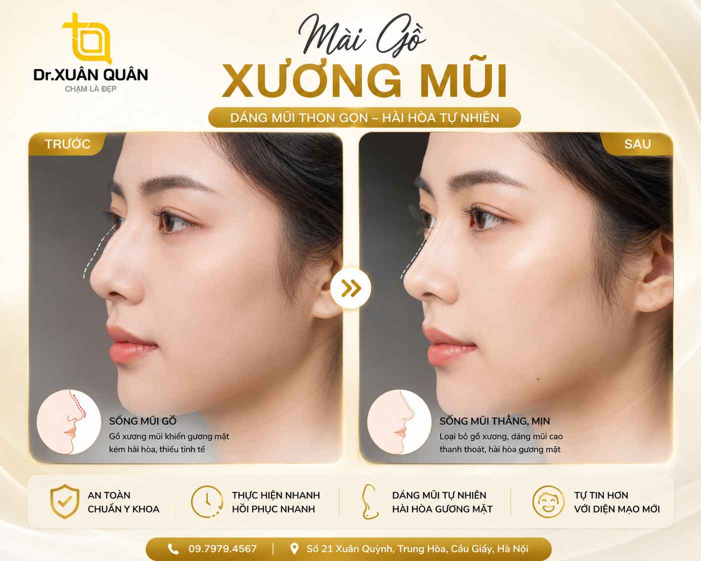 Mài gồ xương mũi Mức giá ưu đãi khi mài gồ xương mũi tại Thẩm mỹ Dr Xuân Quân