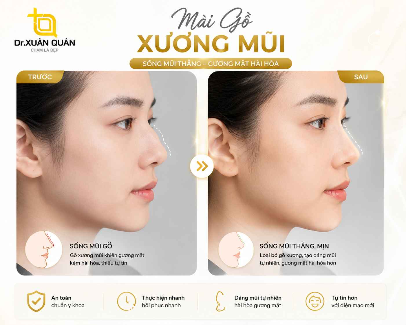 Mài gồ xương mũi Sở hữu nhan sắc hoàn hảo sau khi mài gỗ xương mũi