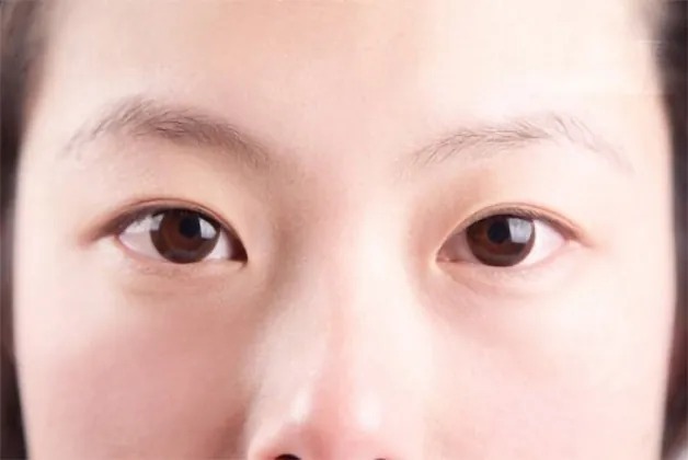 Mắt mí lót là gì? Cách khắc phục mắt mí lót đẹp tự nhiên Nguyên nhân dẫn đến tình trạng mắt mí lót