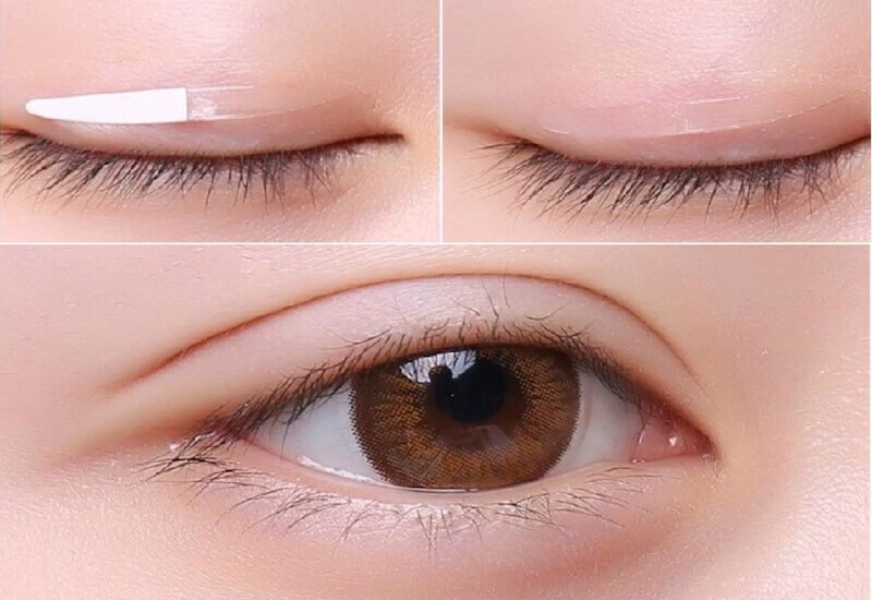 Mắt mí lót là gì? Cách khắc phục mắt mí lót đẹp tự nhiên mắt mí lót