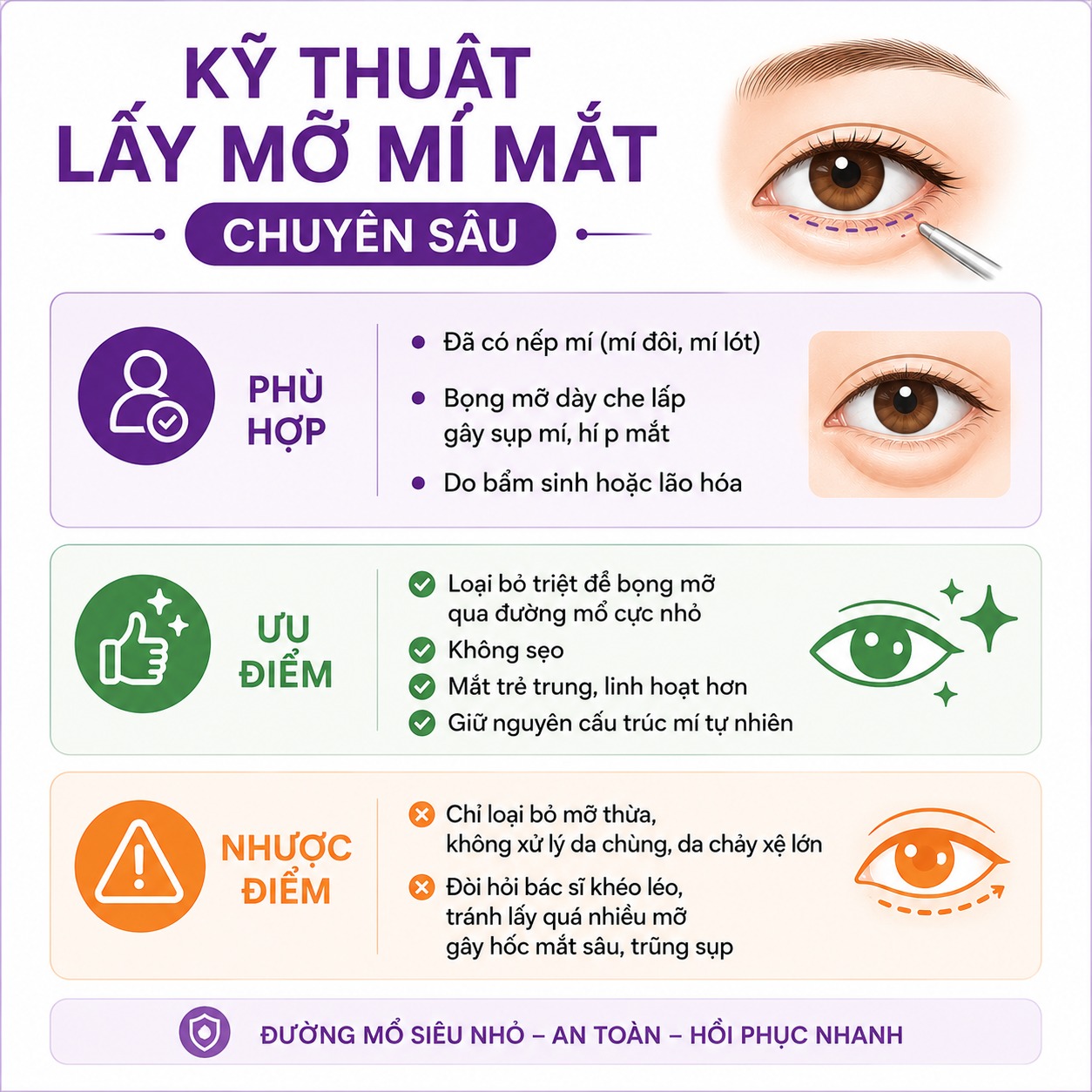 Mắt mí lót là gì? Cách khắc phục mắt mí lót đẹp tự nhiên mắt mí lót