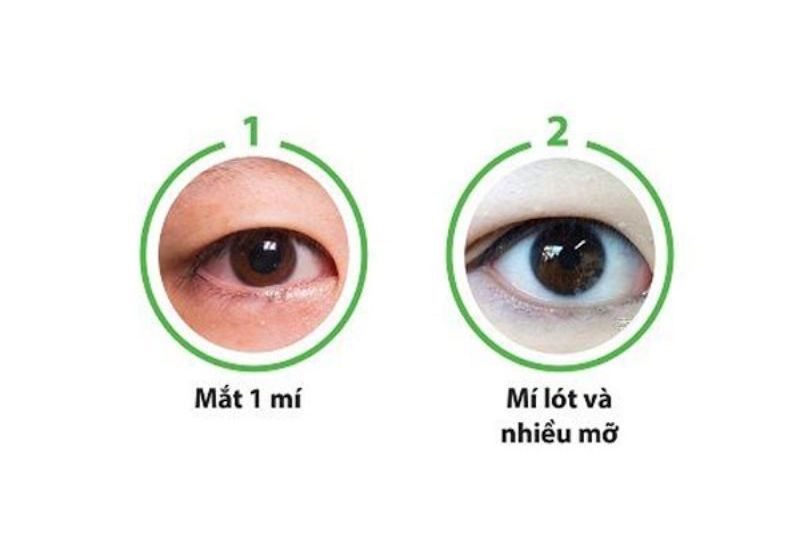 Mắt mí lót là gì? Cách khắc phục mắt mí lót đẹp tự nhiên Mắt mí lót là gì? Cách nhận biết