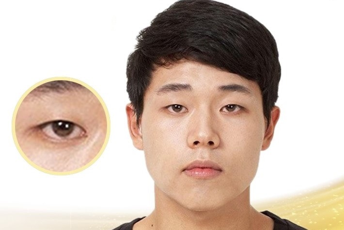Mắt mí lót là gì? Cách khắc phục mắt mí lót đẹp tự nhiên Nam giới có mắt mí lót thì nên chọn phương pháp nào?