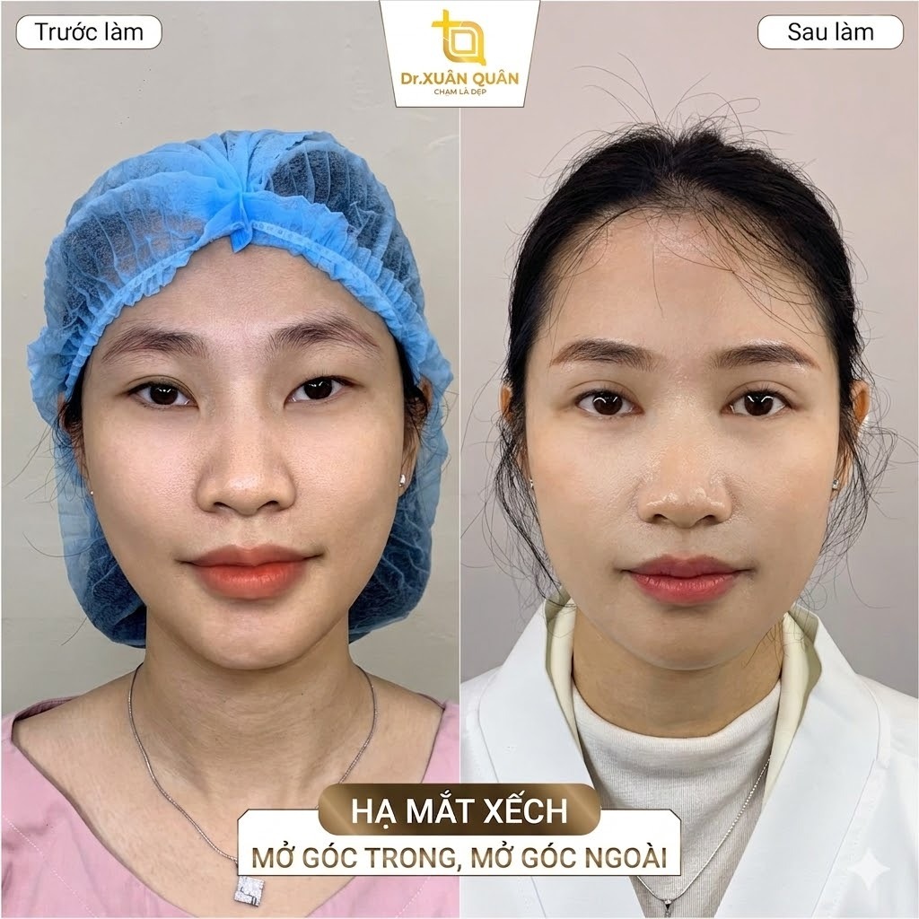 Mắt xếch là như nào? Cách khắc phục mắt xếch giúp mắt đẹp hơn Mở góc mắt hạ xếch