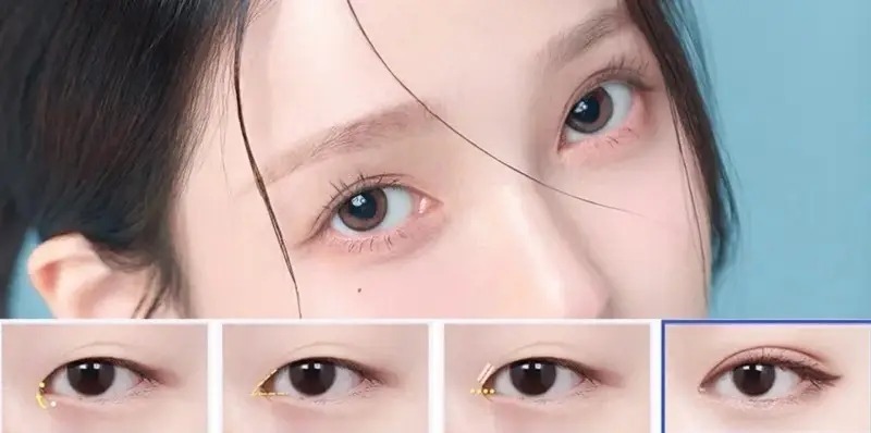 Mở góc mắt Quy trình mở góc mắt chuẩn y khoa