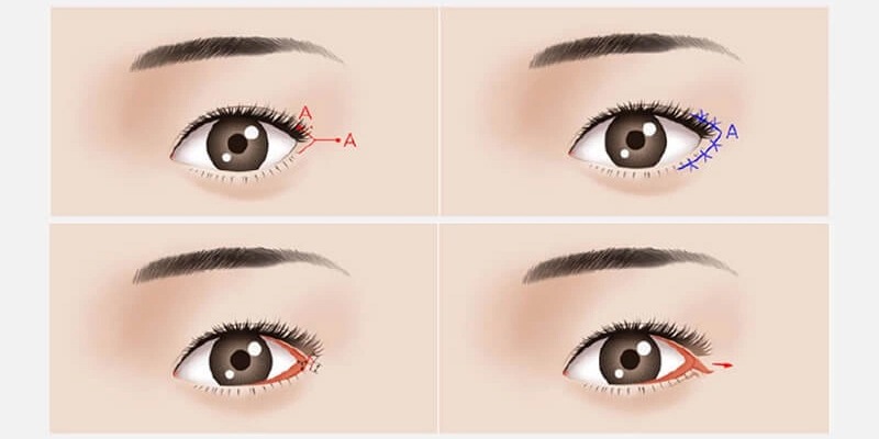 Mở góc mắt Mở góc mắt trong