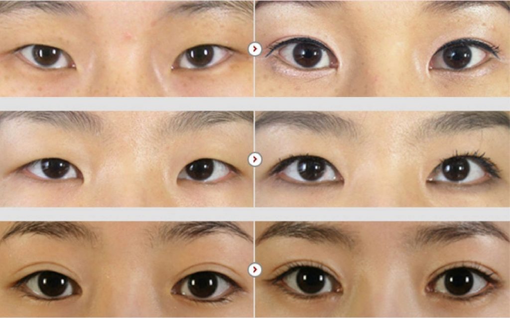 Mở góc mắt Giá mở góc mắt