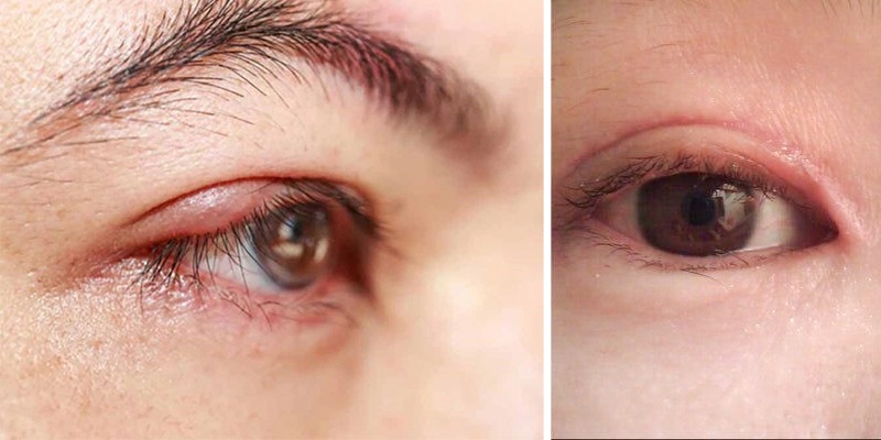 Mở góc mắt trong bị sẹo lồi do đâu? Cách xử lý hiệu quả Dấu hiệu nhận biết mở góc mắt trong bị sẹo