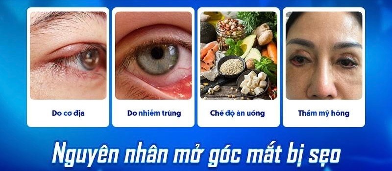 Mở góc mắt trong bị sẹo lồi do đâu? Cách xử lý hiệu quả Nguyên nhân khiến mở góc mắt trong bị sẹo