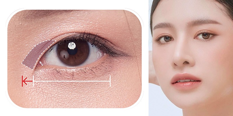 Mở rộng góc mắt có đau không? Bao lâu hồi phục? mở rộng góc mắt có đau không