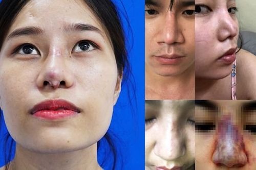 What is nasal capsular contracture? Causes and treatment Nguyên nhân dẫn đến tình trạng nâng mũi bị bao xơ